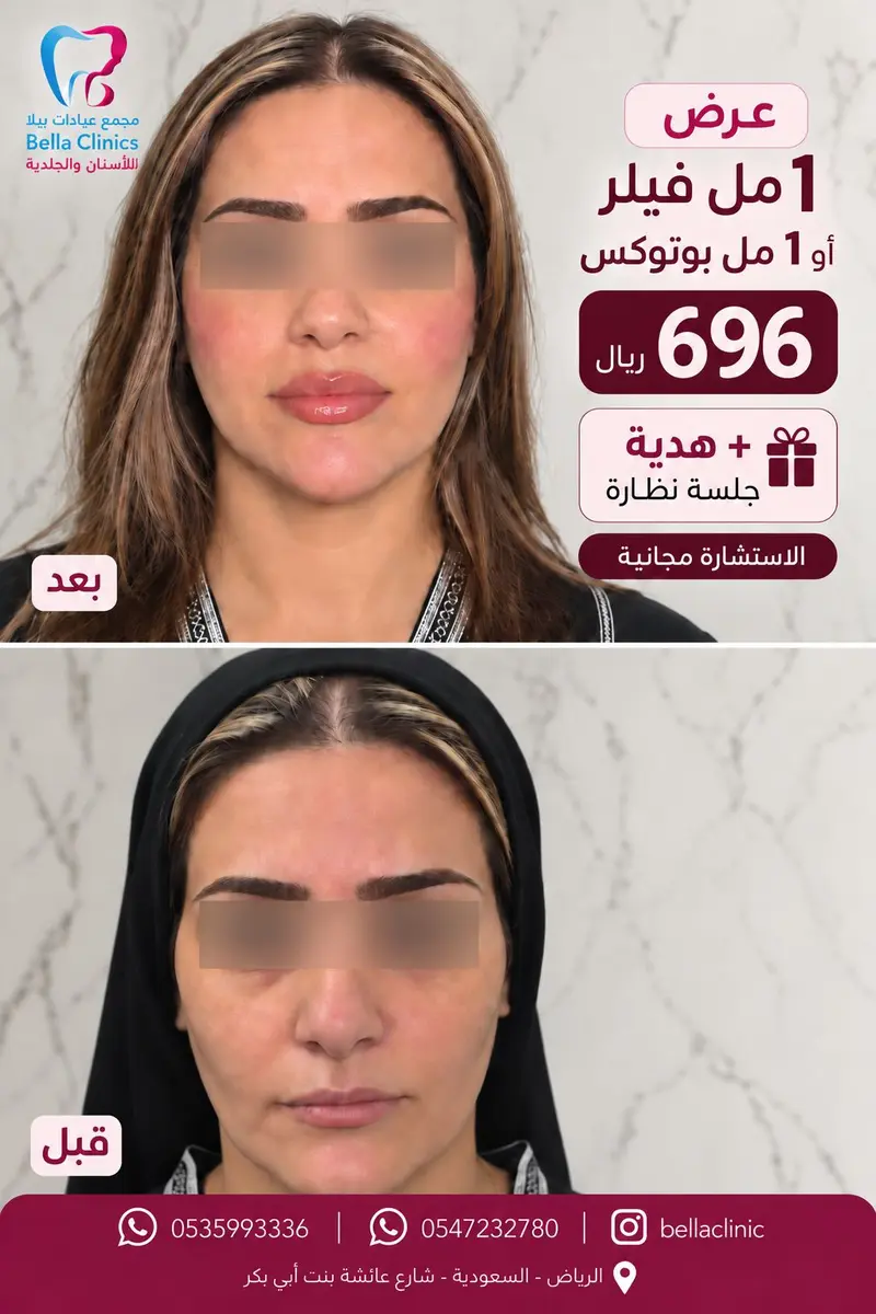 عرض تجميلي من مجمع عيادات بيلا